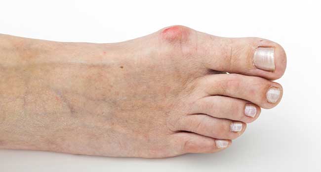 Bunions Treatments | Foot and Ankle Associates Podiatry